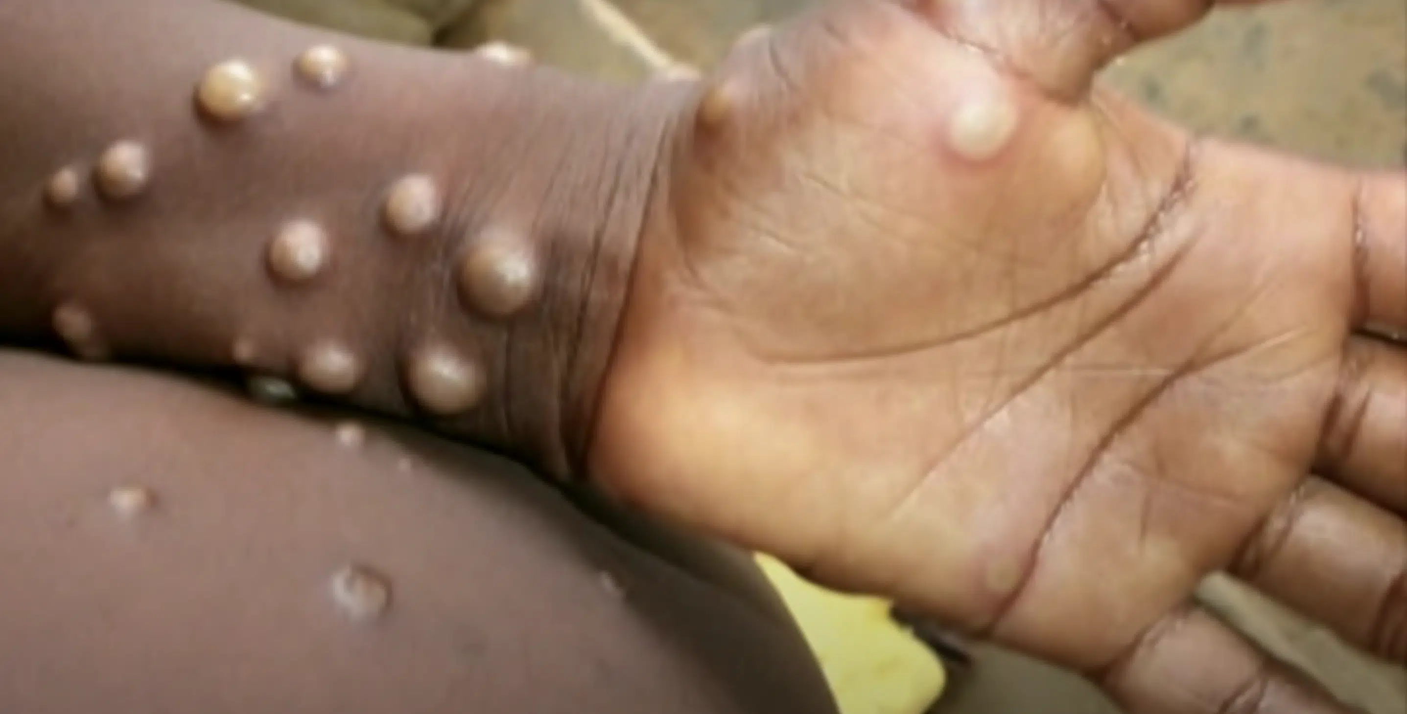 Global Monkeypox Outbreak Calls for Action From WHO Leaders